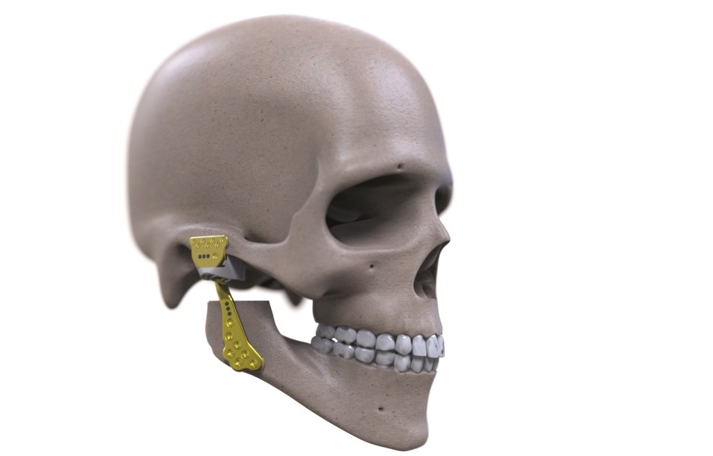 Materialise Invests In Brazilian Implant Manufacturer