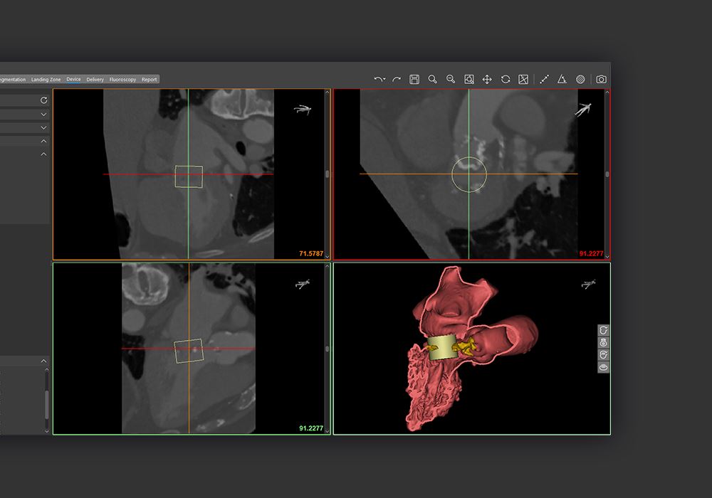 Materialise Enlightens Medical Care With FDA-Approved Cardiovascular Software