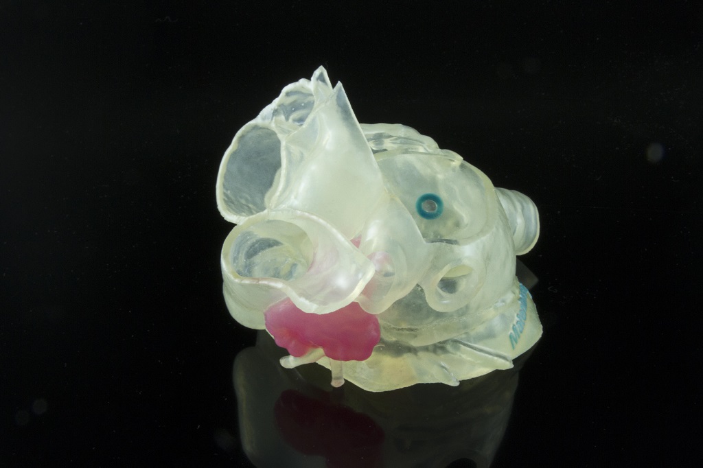 3D printed model of patient’s left atrial appendage (LAA) created with Stratasys and Materialise technology [Image provided by Stratasys] 