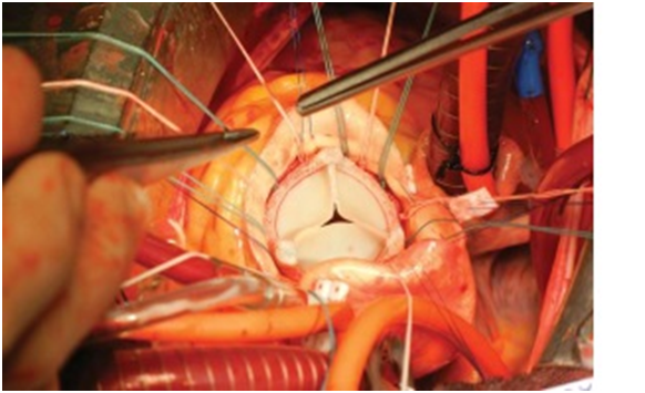   3D Printed Aortic Valve Protectors and Paravalvular Probes During an Aortic Valve Replacement  