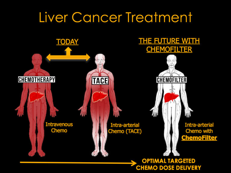  Liver cancer treatment has advanced from intravenous delivery of chemotherapy drugs, which affects not only the tumor and liver but also organs throughout the body (red, left), to intra-arterial chemo (center), which limits the spread of the drug, though up to half can still exit the liver to poison the rest of the body. The proposed absorber would sop up unused drug emerging from the liver, drastically reducing unwanted effects on other organs (right). [Image: UC Berkeley] 