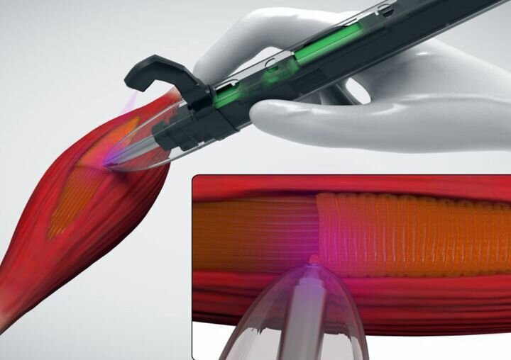 Handheld 3D Bioprinter Enables Muscle Reconstruction