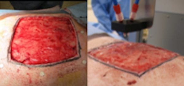  Example of a wound closed by the 3D bioprinting system [Source:  Nature ] 