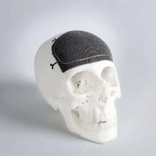  A custom titanium 3D-printed cranio-maxillofacial implant made using EBM technology. (Image courtesy of Arcam.) 