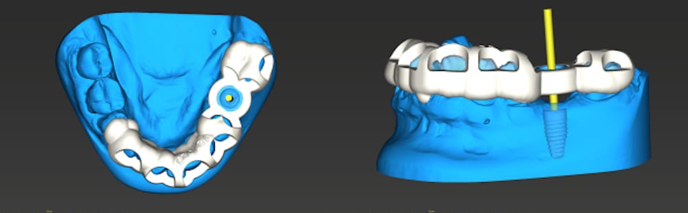  A CAD model of a dental surgical guide 