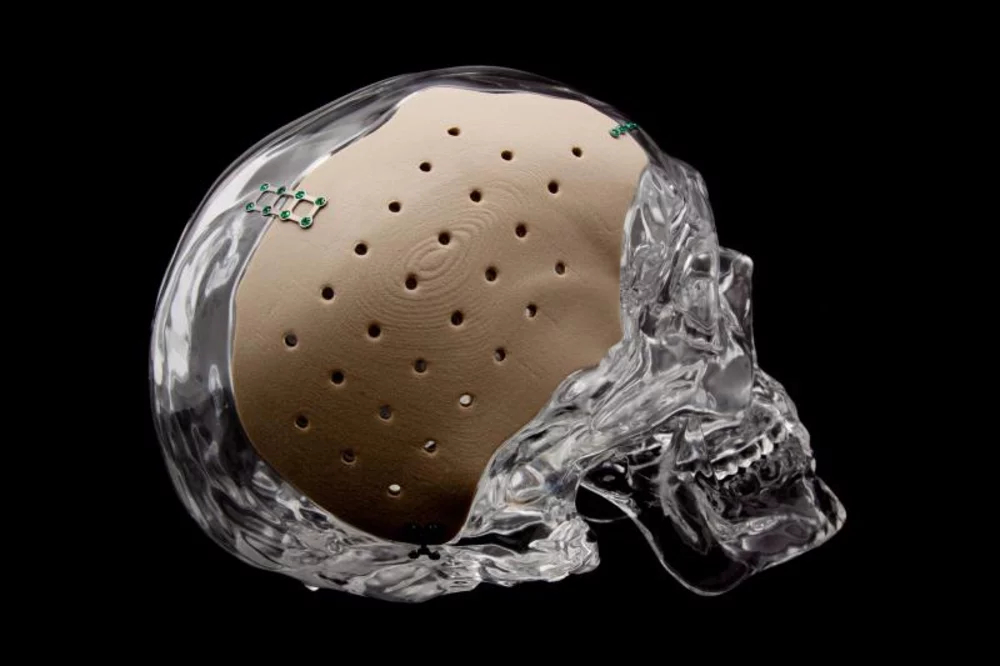  A patient-specific OsteoFab cranial implant 3D-printed by OPM. (Image courtesy of OPM.) 
