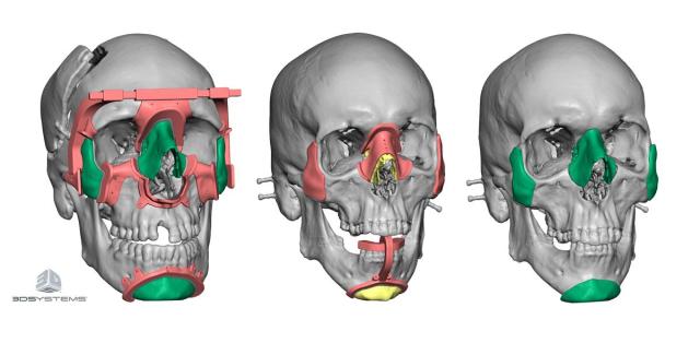 Using patient CT scans, 3D Systems engineers are able to work with doctors to create custom implants and surgical devices. (Image courtesy of 3D Systems.) 