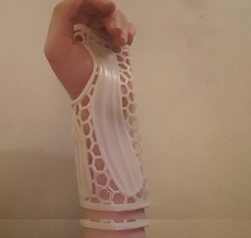  A 3D printed brace - made at home! 