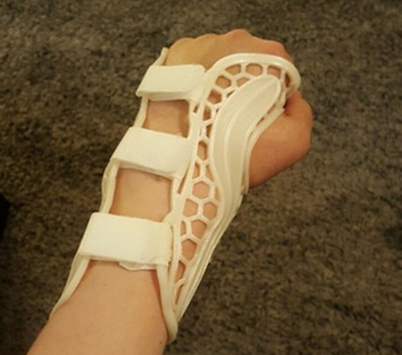  A view of the homemade 3D printed wrist brace showing the velcro fasteners 