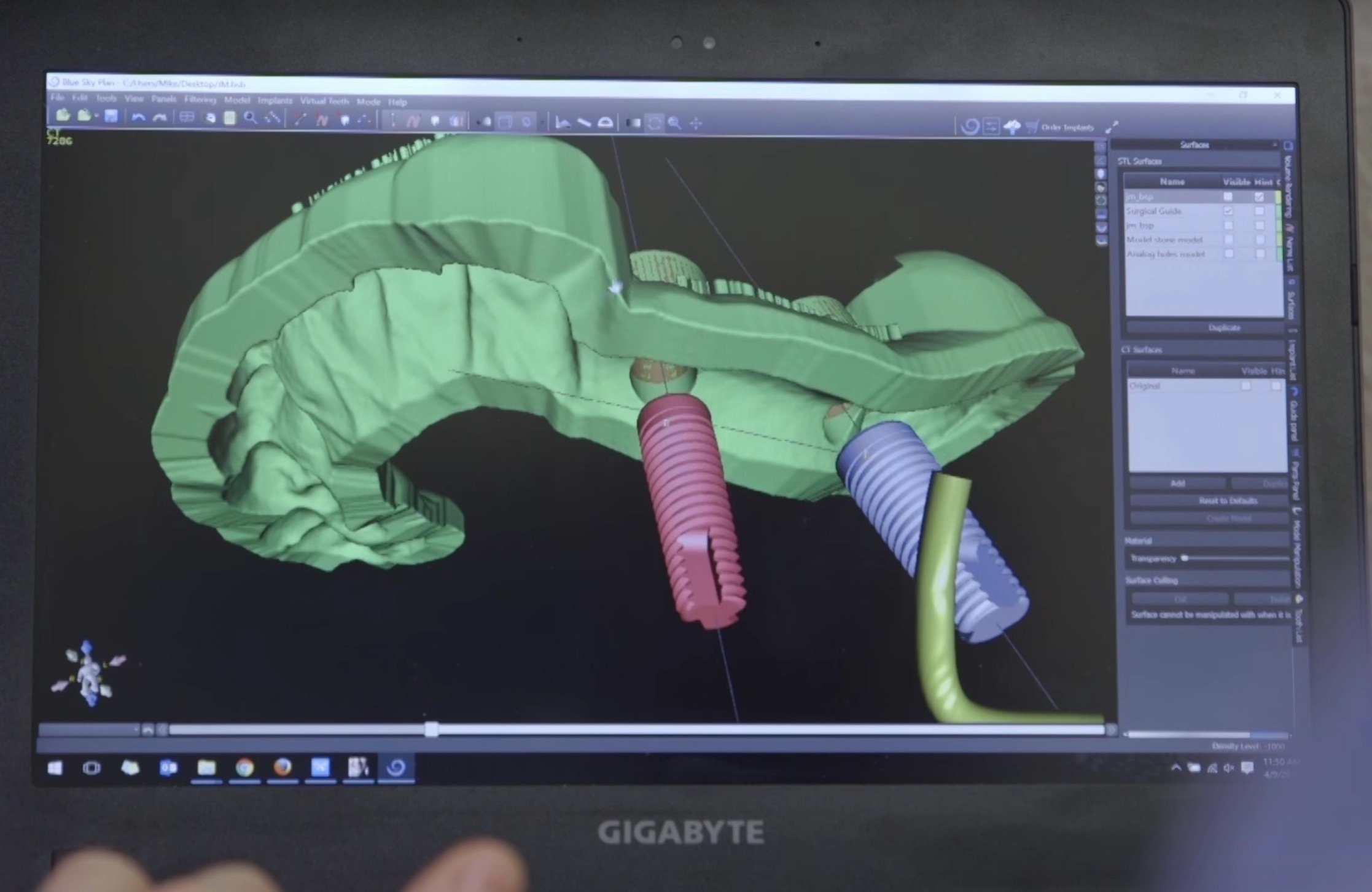  Dentists can design and 3D print custom surgical guides using Formlabs equipment and materials 