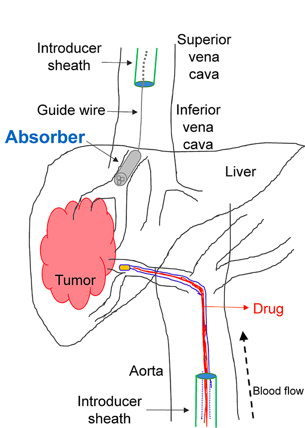  Proposed approach for drug capture using a 3D-printed absorber for endovascular treatment of liver cancer. The chemotherapy drug is administered intra-arterially via a catheter in the hepatic artery (bottom). Excess drug is captured by the absorber in the vein draining the organ (vena cava, top). [Image: UC Berkeley] 