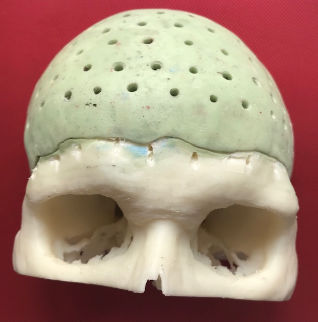 3D Printing More Affordable Cranial Implants