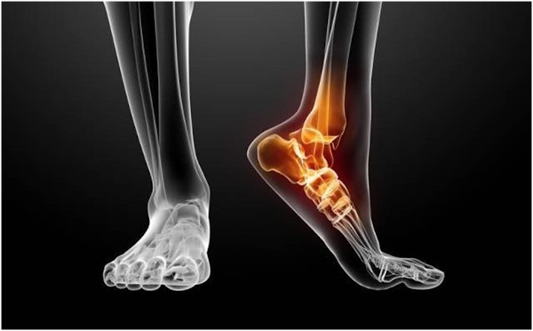 3D Printing Aiding In Ankle Surgery