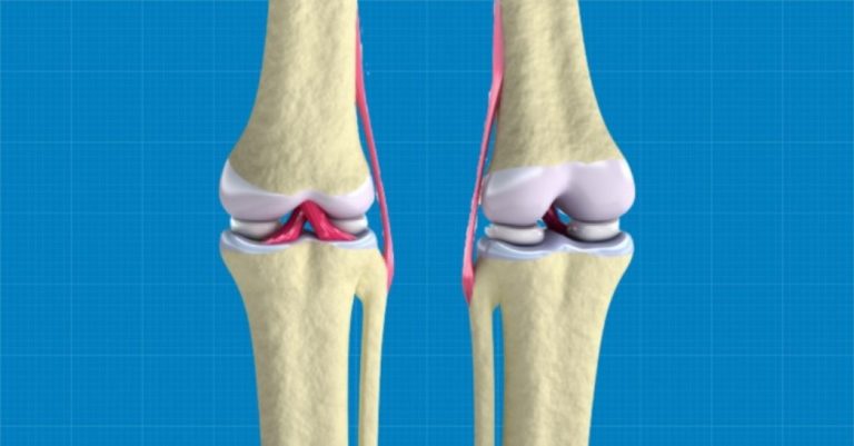 bioprinting-cartilage-tissue-to-help-knees-function-again-fabbaloo