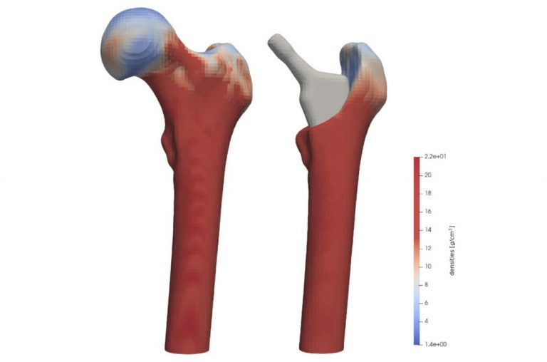 Optimizing 3D Printed Medical Implants