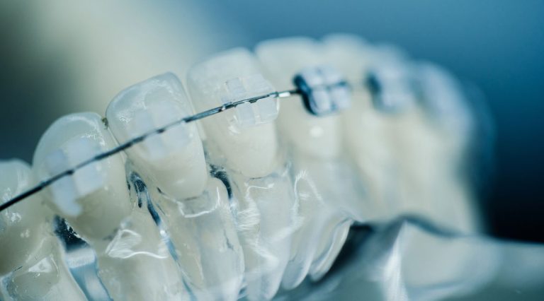 Revolutionizing Orthodontics: How 3D Printing Achieves True Success